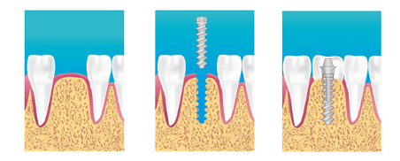 implant dentaire vernon